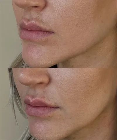 Before and after lip enhancement comparison.