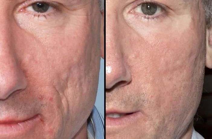 Before and after skin texture comparison.