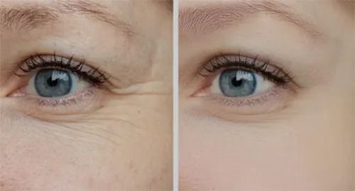 Before and after eye wrinkle treatment comparison.