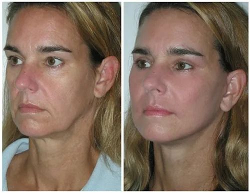 Before and after facial rejuvenation treatment comparison