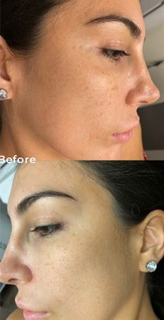 Before and after skincare treatment comparison.