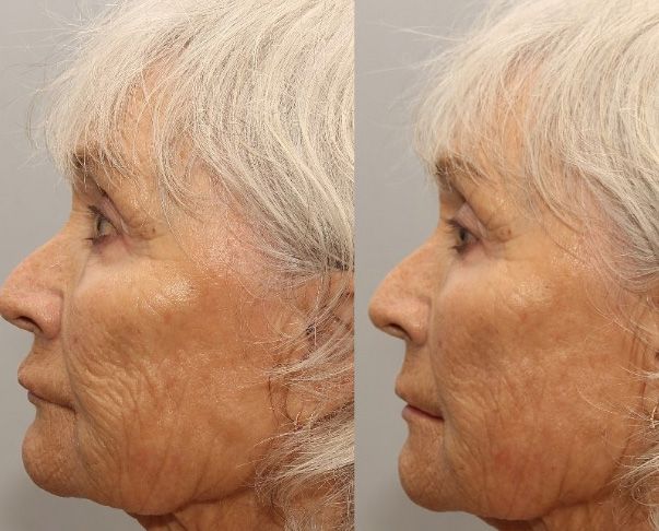 Before and after facial rejuvenation treatment comparison.