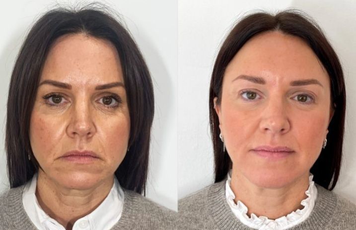 Before and after facial rejuvenation treatment.