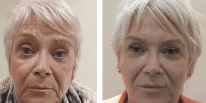 Before and after facial rejuvenation treatment.