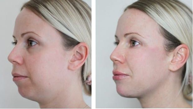 Before and after facial profile comparison.