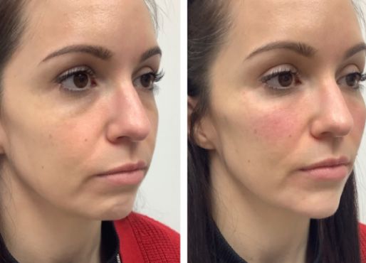 Before and after facial treatment comparison photo.
