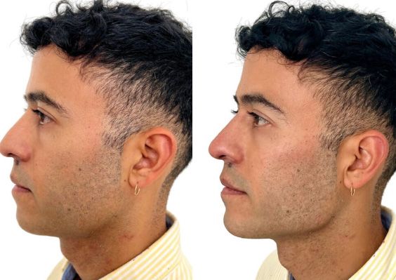 Man's profile before and after haircut.