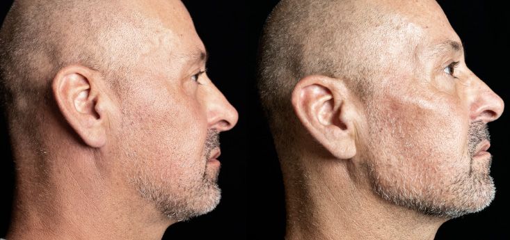 Profile comparison of two men with shaved heads.