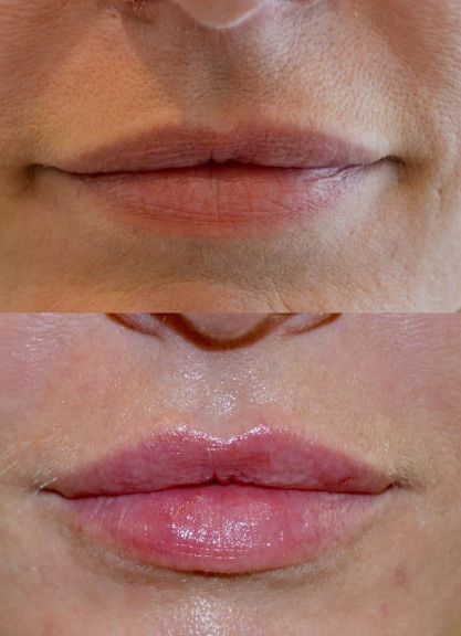 Before and after lip enhancement comparison.