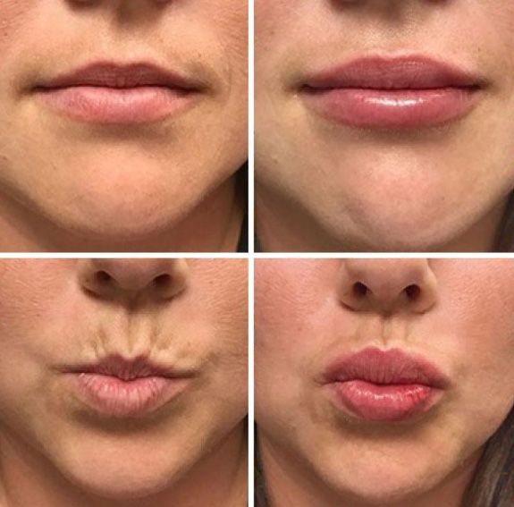 Before and after lip treatment comparison images.