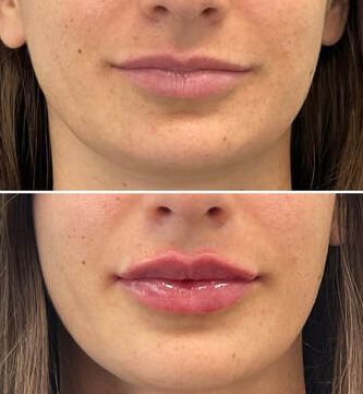 Before and after lip enhancement treatment.