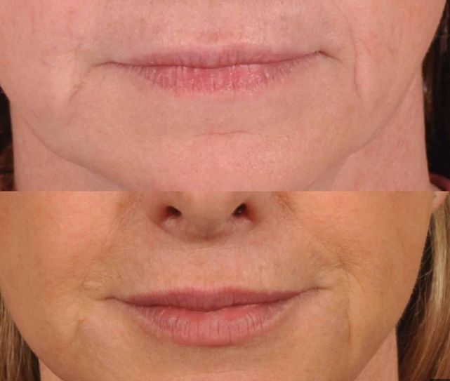 Comparison of two different lip conditions.