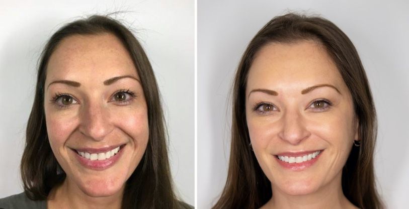 Before and after facial rejuvenation treatment photos.