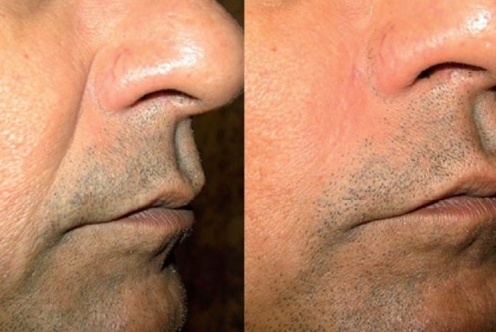 Before and after nose and lip enhancement procedure.