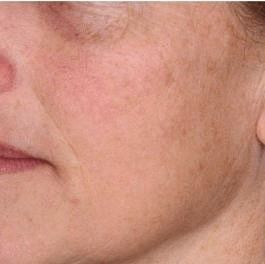 Close-up of a woman's cheek and jawline.