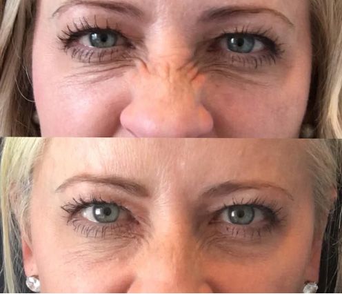 Before and after skincare treatments.
