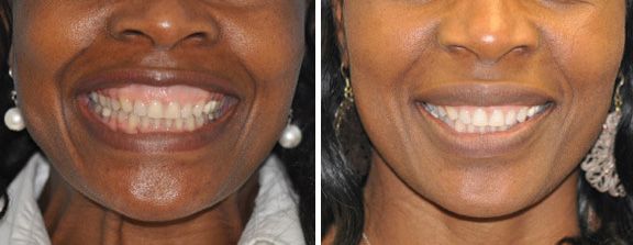 Teeth before and after dental treatment comparison.