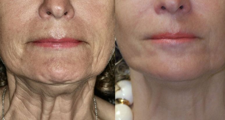 Before and after skin treatment comparison.