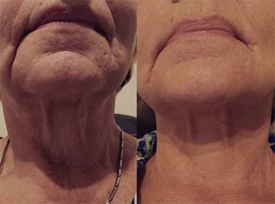 Before and after neck skin treatment comparison.