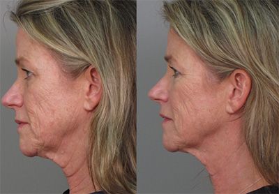 Before and after facial rejuvenation treatment results.
