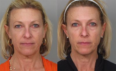 Before and after facial rejuvenation treatment comparison.