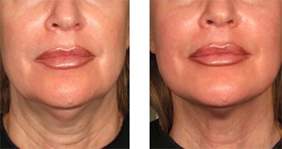 Before and after cosmetic treatment comparison.