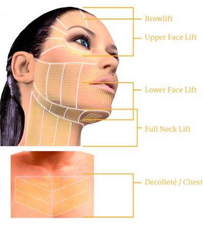 Facial lifting techniques and areas illustrated diagrammatically.