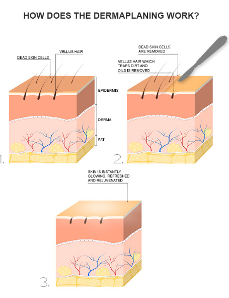 Dermaplane diagram