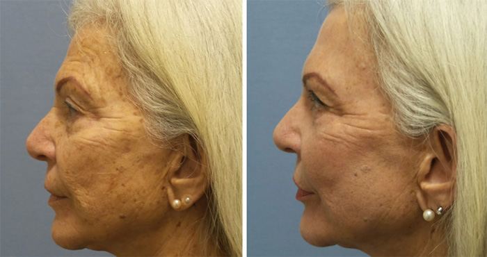 Laser Resurfacing Female BnA