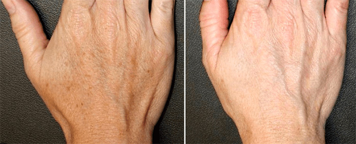 Laser Resurfacing Hands