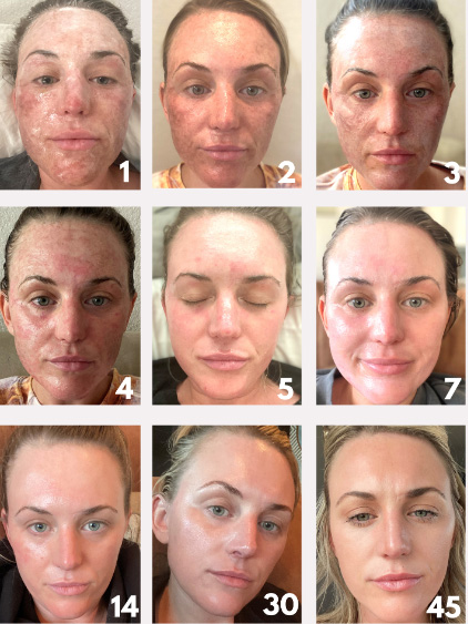 Laser Resurfacing Phases