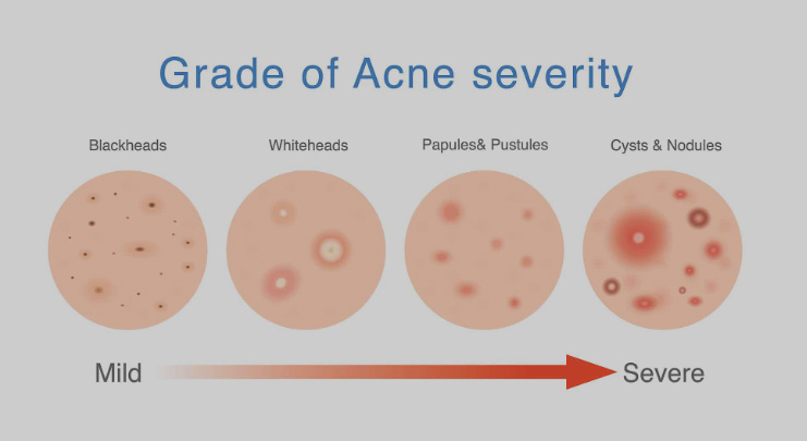 Phases of Acne Diagram