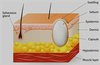 Sebaceous Cyst Diagram