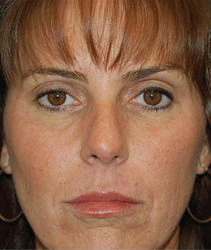 BioMedic / MicroPeel