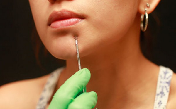 Blackhead Extraction Santa Fe NM