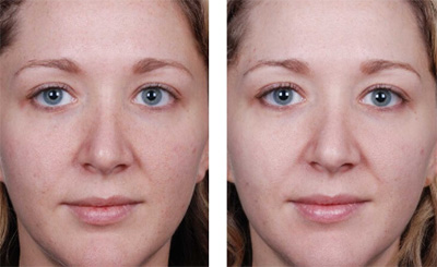 Blue Radiance Before and After | Chemical Peels in Santa Fe, NM