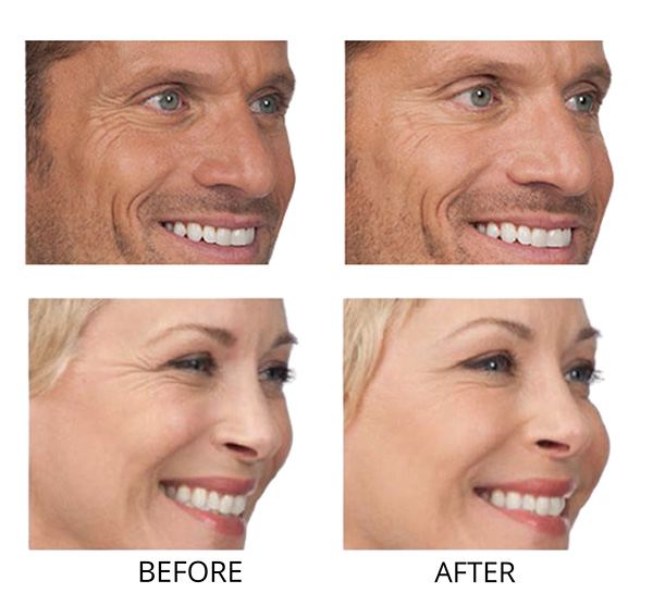 Botox Injections for Crows Feet in Women