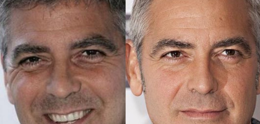 Botox for Men Santa Fe NM