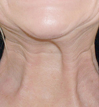 Botox® for Neck Bands