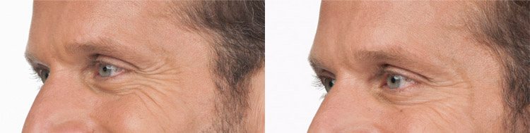 Botox Injections for Crows Feet in Men