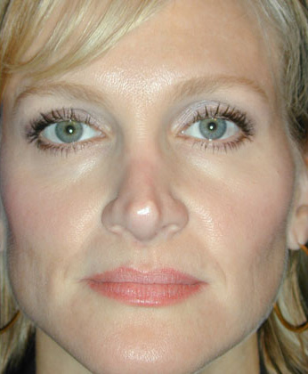 Botox® brow lift after