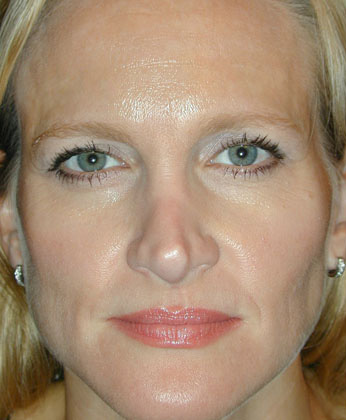 Botox® brow lift before