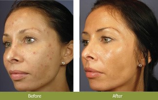 Chemabrasion Santa Fe NM