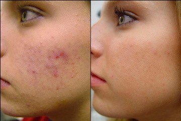 Clear Complexion Facial Santa Fe NM