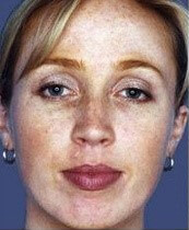 Deep Chemical Peel