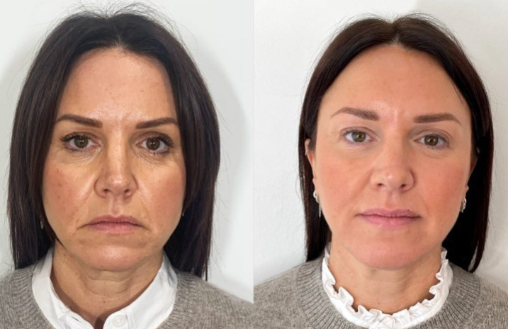 Dermal Filler BnA Cheeks and Temples