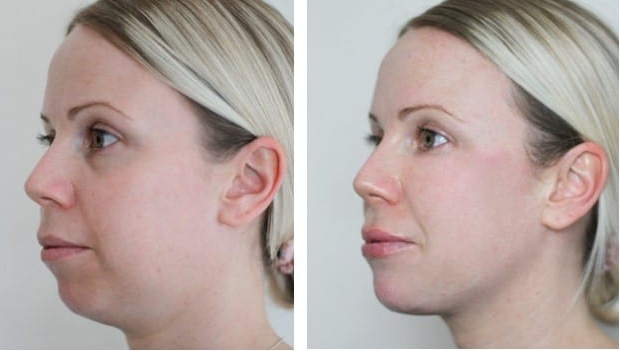 Dermal Filler Jawline and Chin female 2