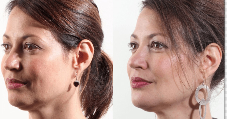 Dermal Filler Jawline female