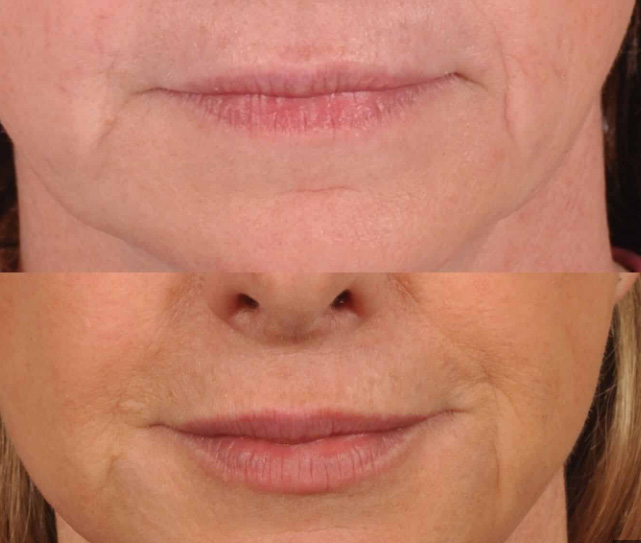 Dermal Filler Mid Age