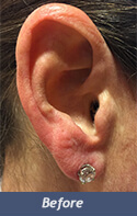 Earlobe Enhancement